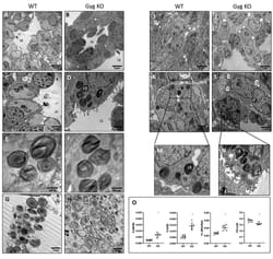 Pulmonary glycogen deficiency as a new potential cause of respiratory distress syndrome