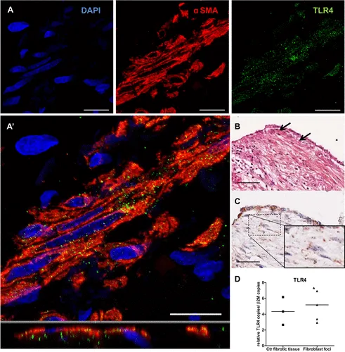 Toll-like receptor 4 activation attenuates profibrotic response in control lung fibroblasts but not in fibroblasts from patients with IPF